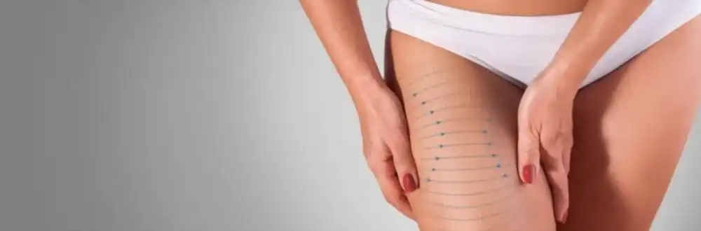 Lifting des Cuisses en Tunisie : Des Jambes Raffermies et Élégantes