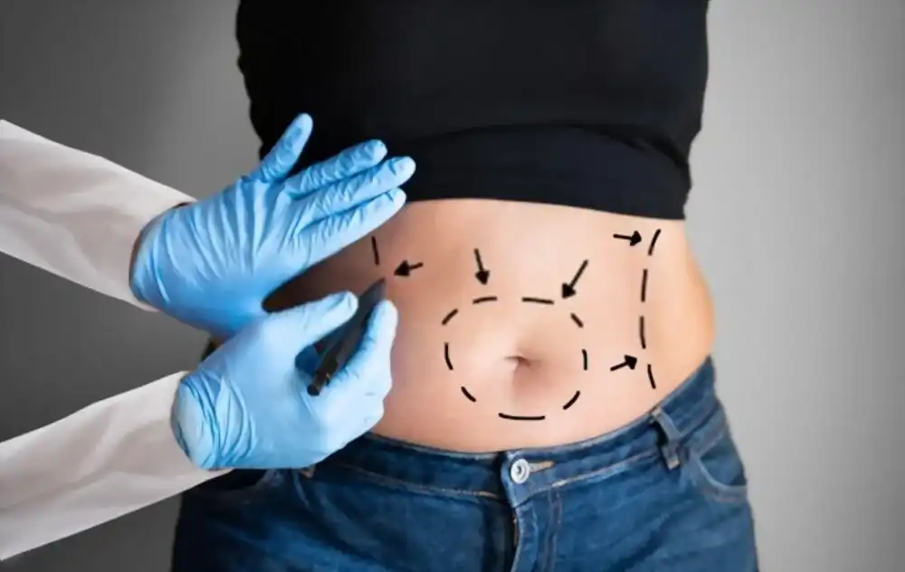 Mini Abdominoplastie en Tunisie : Une Solution Ciblée pour un Ventre Parfait