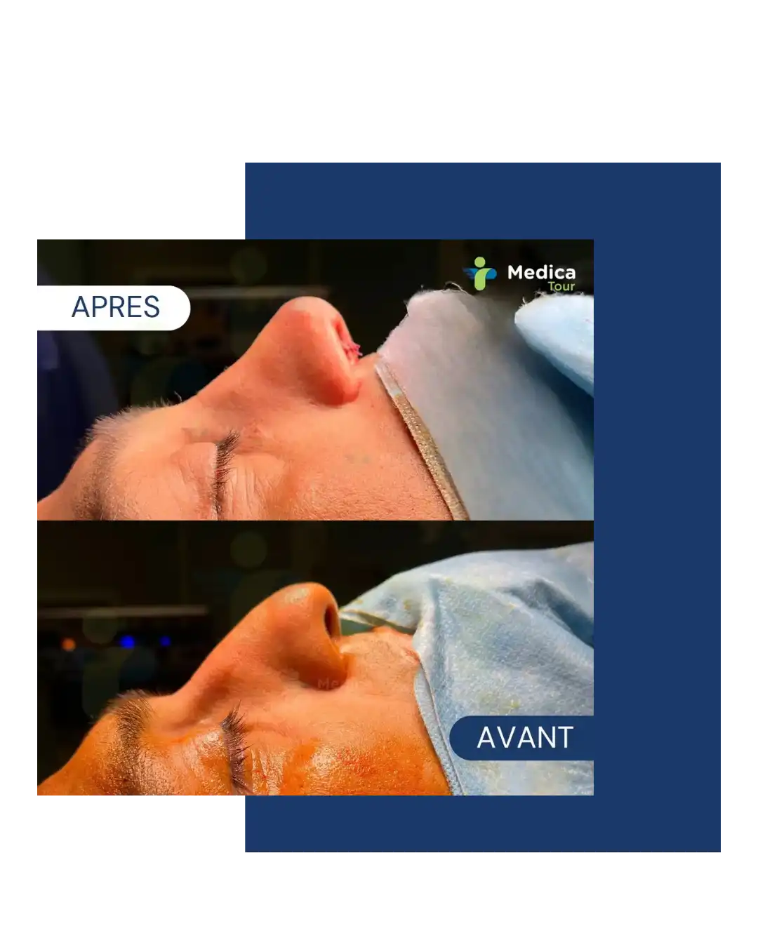 Résultat avant/après rhinoplastie en Tunisie