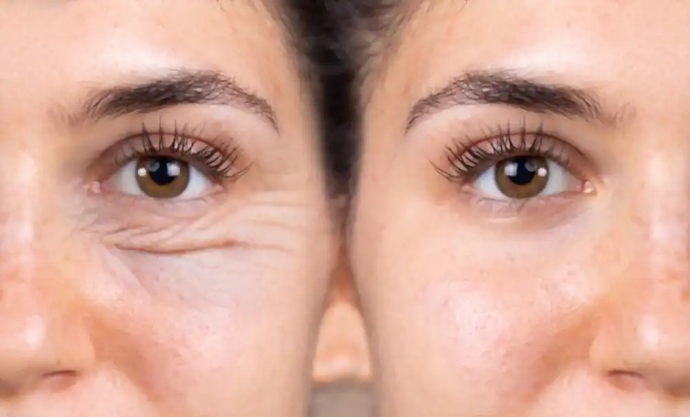 Blépharoplastie en Tunisie : Rajeunissez Votre Regard avec Medica Tour
