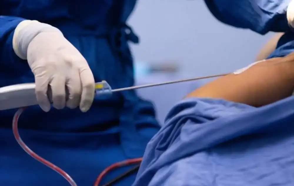 Liposuccion en Tunisie : Affinez Votre Silhouette avec Medica Tour