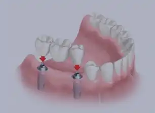 Bridge et Couronne Dentaire en Tunisie : restaurer votre sourire durablement