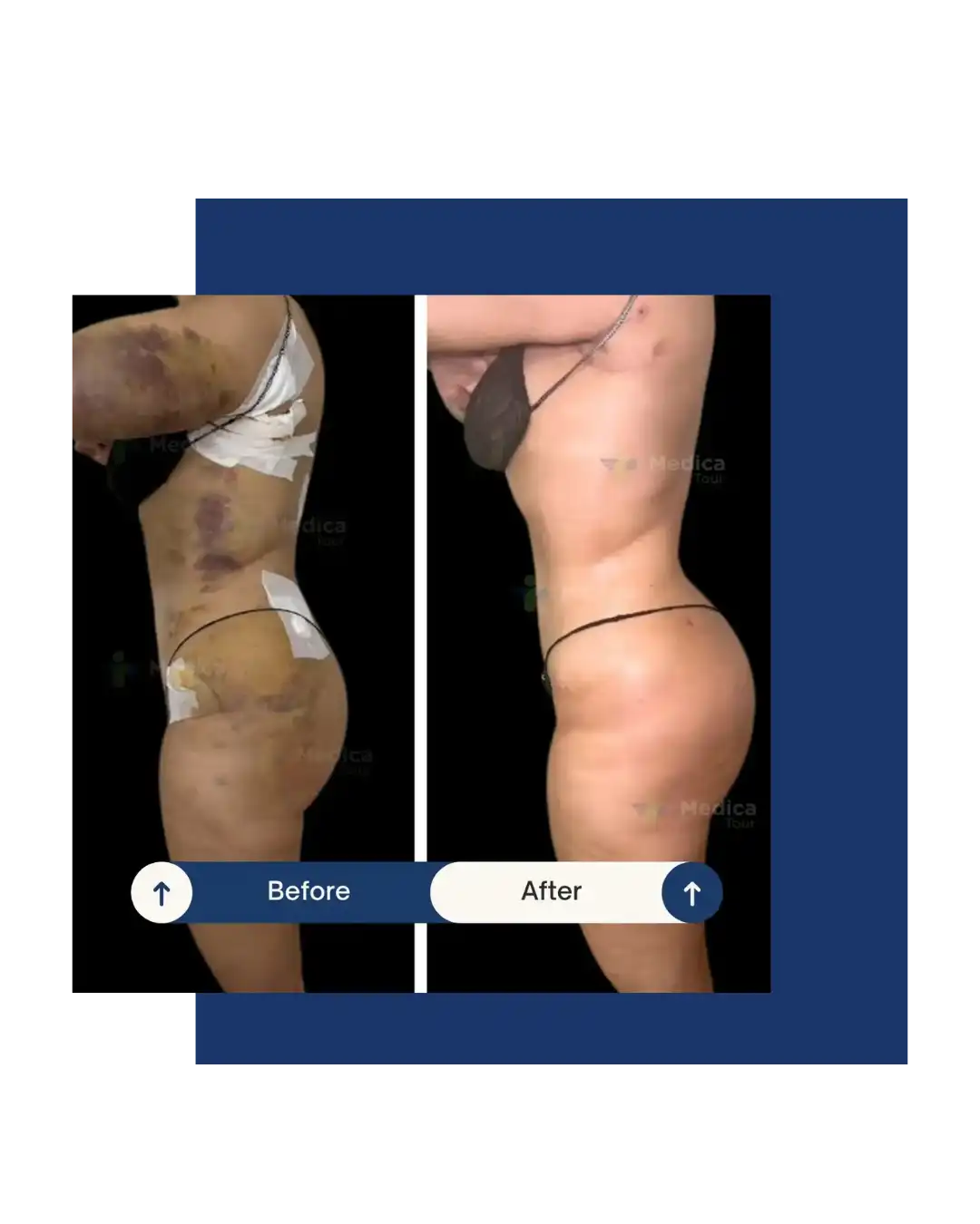 Résultat avant/après liposuccion en Tunisie