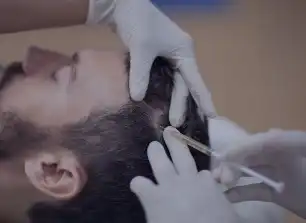 PRP Cheveux en Tunisie : la solution naturelle pour stimuler la repousse