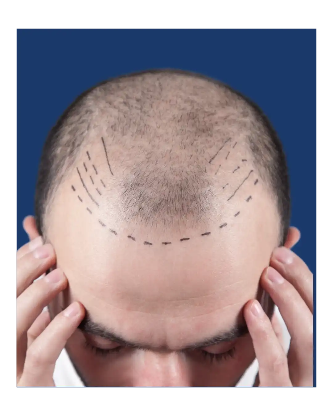 Greffe de cheveux en Tunisie pour homme et femme : FUE, DHI, implants capillaires