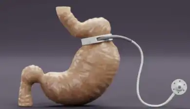 Anneau gastrique en Tunisie : Une Solution Bariatrique Peu Invasive