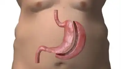sleeve gastrique en Tunisie : Une Chirurgie Efficace contre l’Obésité Sévère