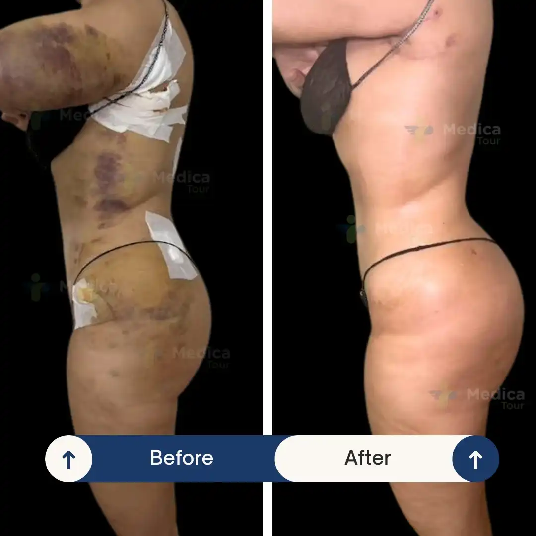 Résultat avant/après liposuccion en Tunisie